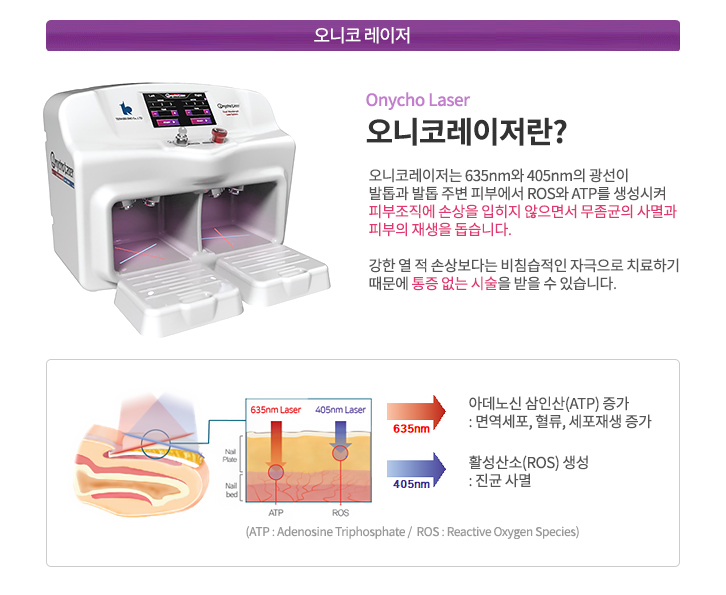 오니코레이저란